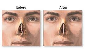 nasal polypectomy procedure